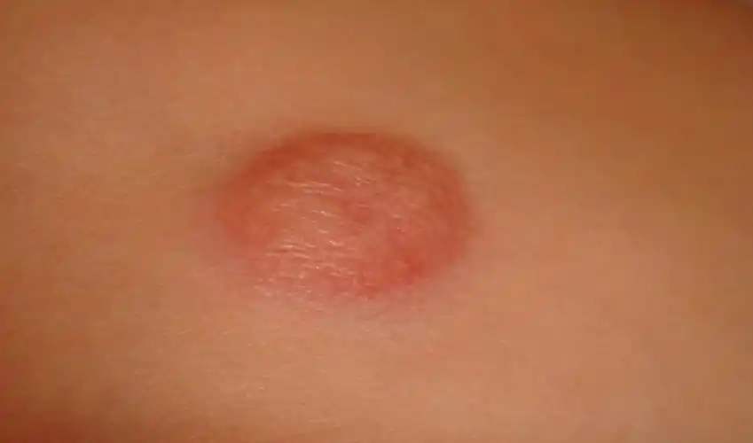 割它如割韭菜!" 一位隆突性皮肤纤维肉瘤患者的求医之路.