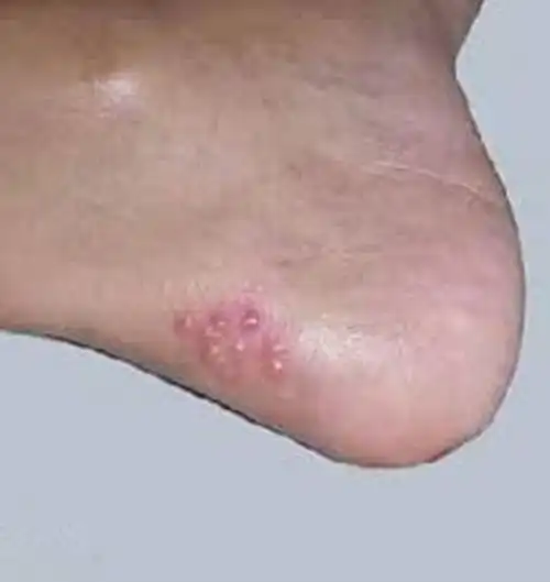 人得了一期梅毒怎么办图片