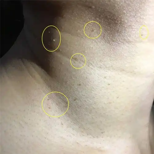 腐蚀去除脖子上的小肉粒肉球肉赘疙瘩孕妇丝状身体磨砂膏