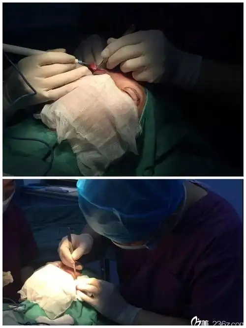 双眼皮 开眼角手术过程中