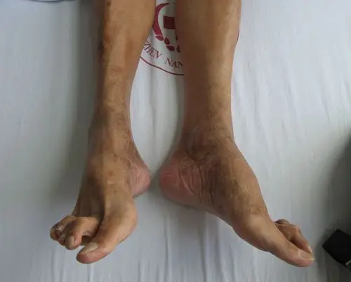 糖尿病足症状
