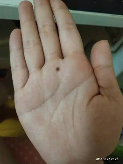 您好,请问女官星入墓,手掌又有痣克姻缘,是不是没得治了?