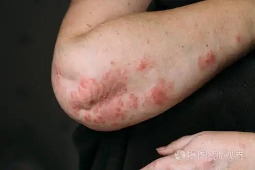 手肘上的牛皮癣红斑点干片状皮肤特写照片