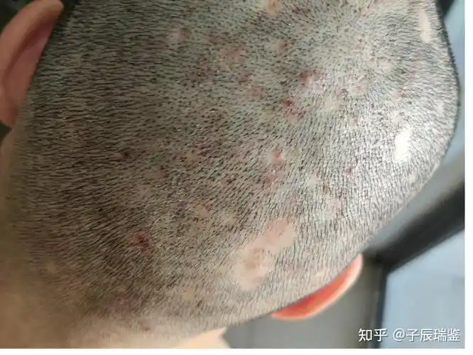 毛囊炎治疗之路(非药托)