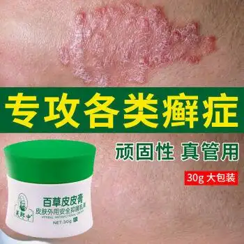 牛皮l癣膏箹特效紫椒癣町手足l癣荨l麻疹皮l炎湿l疹皮肤瘙痒百草止痒
