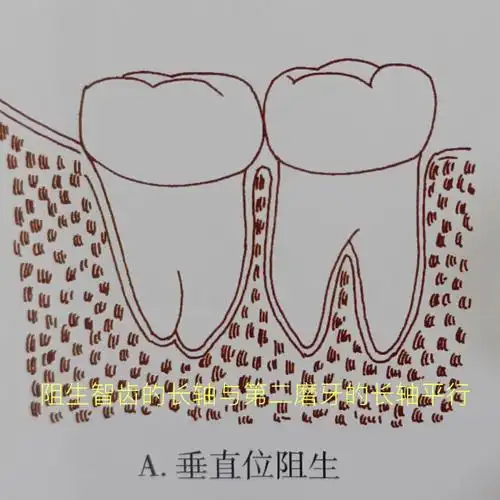 下颌阻生智齿的分类标准