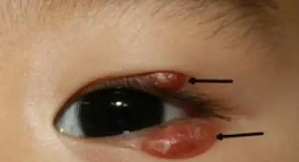 儿童霰粒肿如何治疗