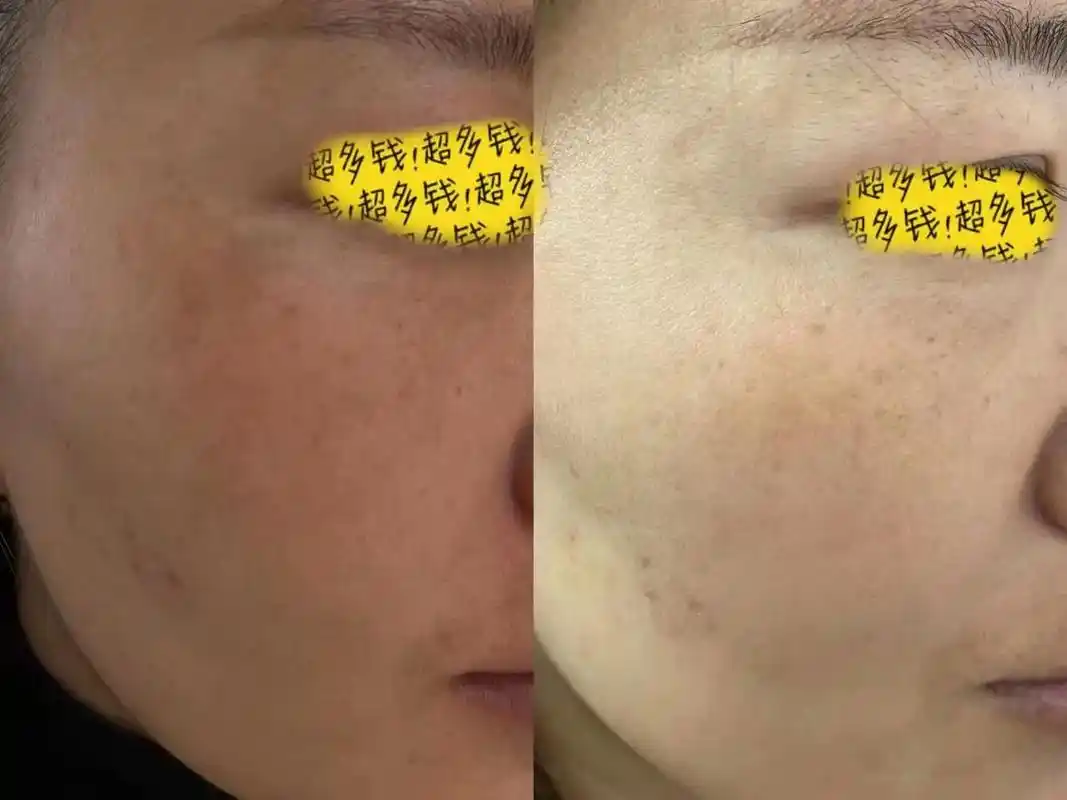 美女用美白进口霜20天的对比图#好皮肤都是养出来的  - 抖音