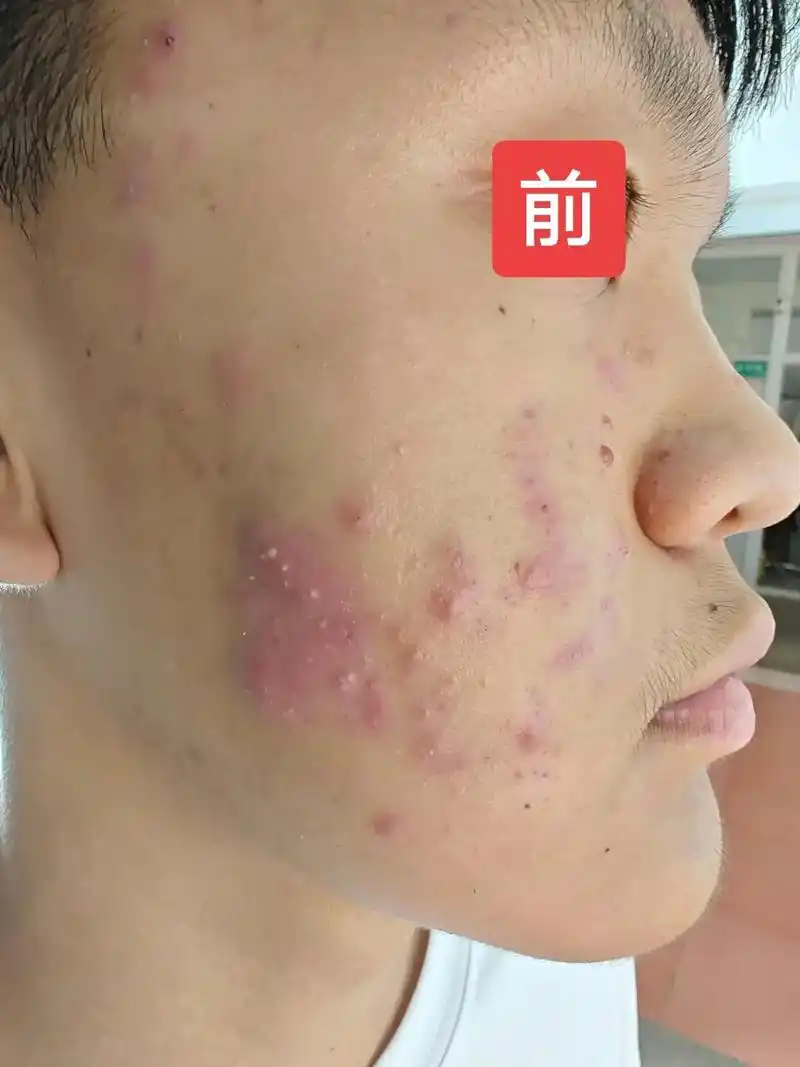 对比图.只剩下痘印了#问题性皮肤管理 #青春痘粉刺痤疮 - 抖音