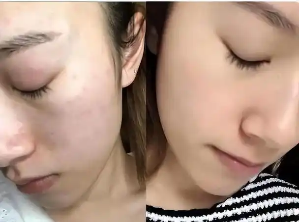 刚打湿脸就直接用洗面奶?难怪你总长黑头粉刺,教你正确洗脸方式