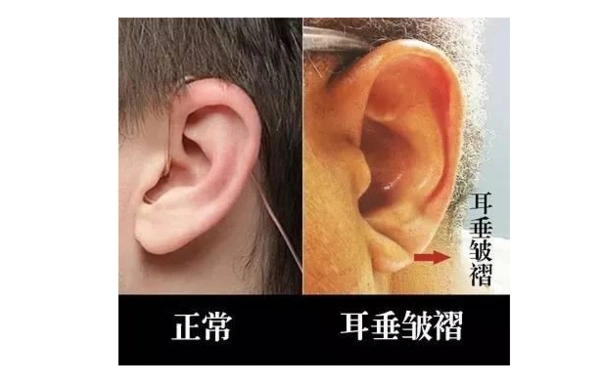 耳朵上有这个东西千万要注意,很可能有冠心病!