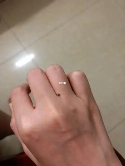 有痣指间