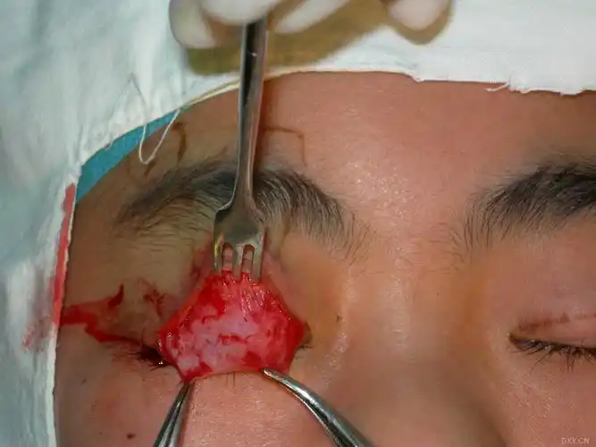 【讨论】额肌筋膜瓣治疗上睑下垂,兼做拜年帖! [精华] [病例帖]