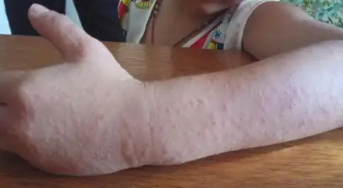 夏季皮肤过敏什么原因