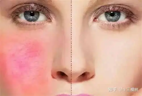 皮肤屏障受损的后果