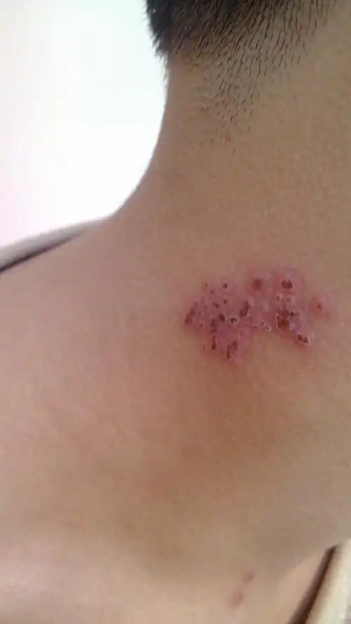 脖子上长了一些红色像小水泡的东西~不痛也不痒~这是什么啊
