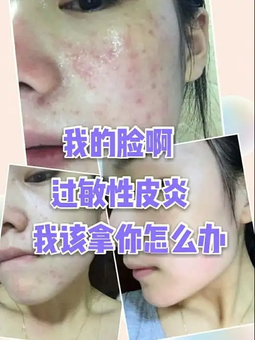 我的脸啊过敏性皮炎我该拿你怎么办
