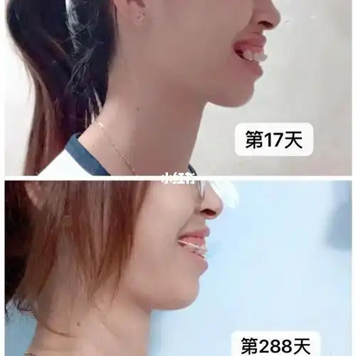 正畸之旅_牙齿矫正_智齿_龅牙_拔牙_矫正牙齿_美妆_医美整形