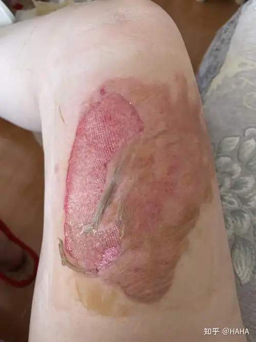 烫伤自我在家换药过程 - 知乎
