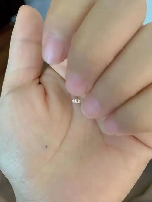 手心忽然长出的痣