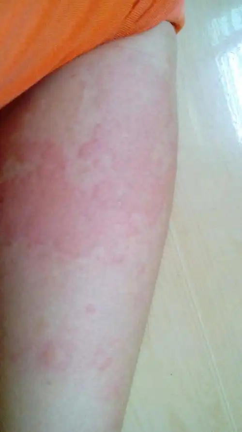 求治皮肤过敏的药,急!