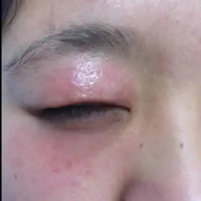 现在马上四个月了,连续三天一到晚上上眼皮就肿了