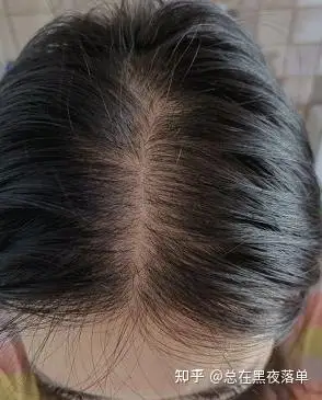 吃黑芝麻丸究竟有什么好处真的能让头发变黑变浓密吗