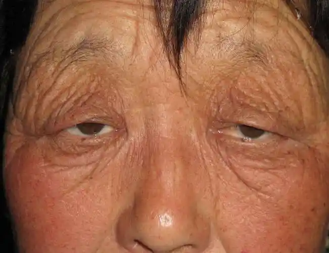 老年性上睑下垂