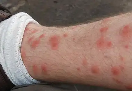 被跳蚤咬的症状图片(19)