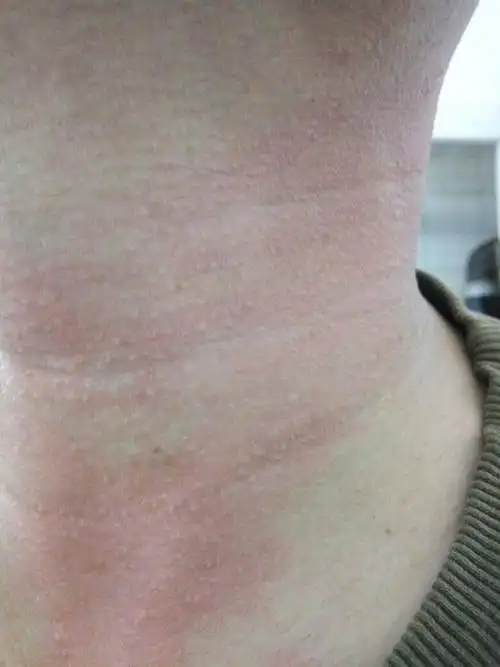 脖子突然发现红了一片怎么回事谢谢