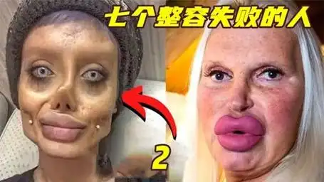 美女变奇葩  七个整容失败的典型案例 2_2