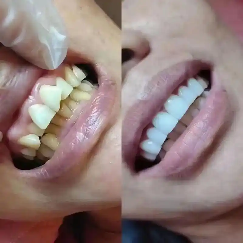 瓷贴面作品,用心做好每颗牙,坚持不忘初心,保证不辜负每一位 - 抖音