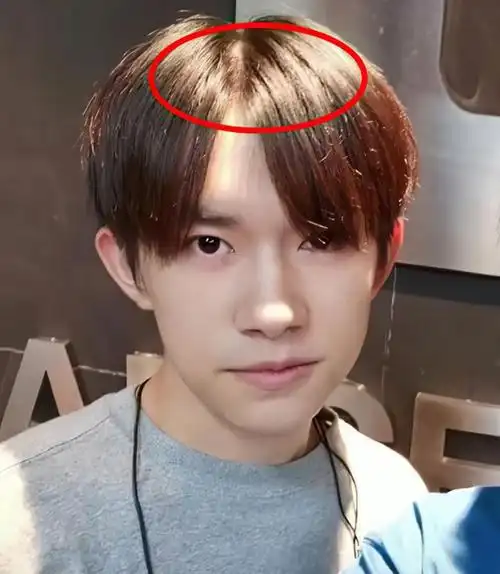 并晒酒店合照,发缝大到粉丝不敢信是本人|tfboys|刘海|发际线_网易