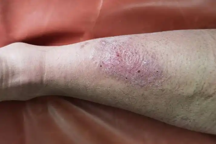 慢性湿疹图