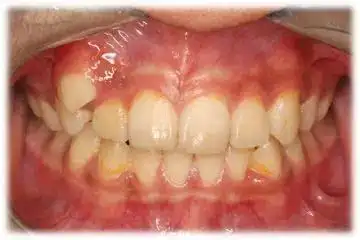 尖牙vs虎牙 这次我pick这颗长得壮又能吃的牙_儿童牙病_疾病介绍_相关