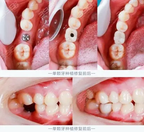 你知道韩国种植牙价格吗登腾种植体含全瓷冠多少钱一颗