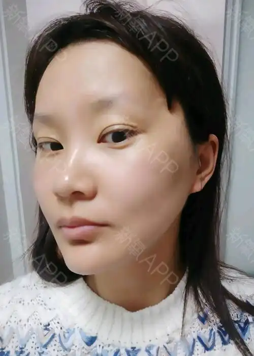 自体脂肪填充额头