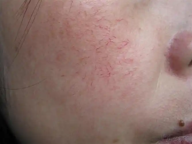 面部红血丝如何治疗?