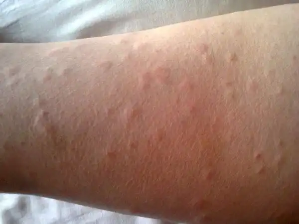 荨麻疹的7种类型,你属于哪一种?