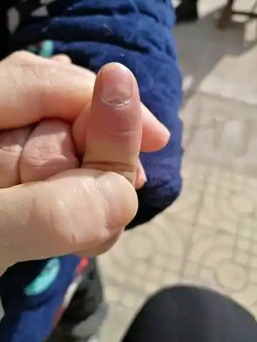 小孩手指甲这样是什么原因?