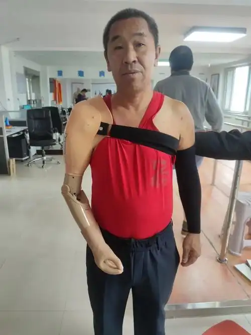 2机械型假肢美容型假肢穿戴舒适,操作简单,外观上更逼真.no.