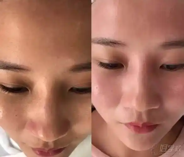 前后皮肤管理对比