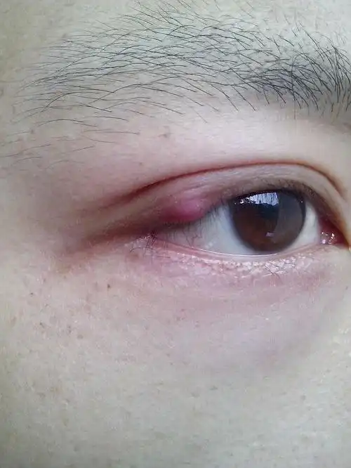 求大家看一下,这是霰粒肿吗?