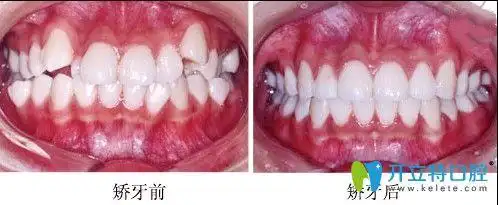 案例二:牙齿症状:虎牙;矫正方式:隐适美隐形矫正.