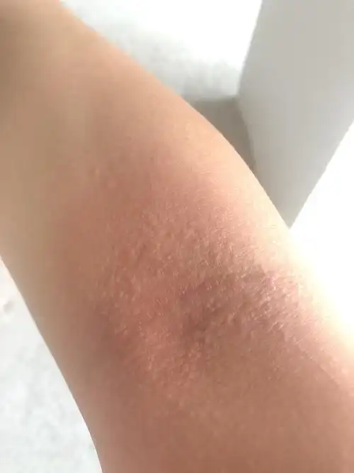 这是什么皮肤病?