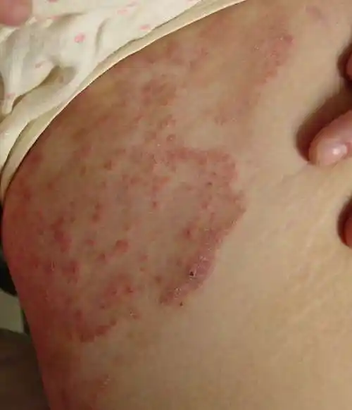 尤立平主任医师谈:股癣(一种容易误治的皮肤病)