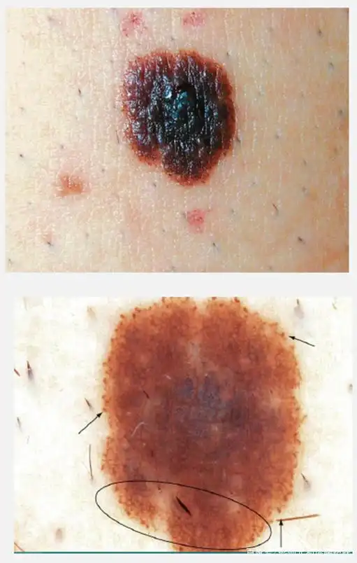 黑色素瘤的皮肤镜表现