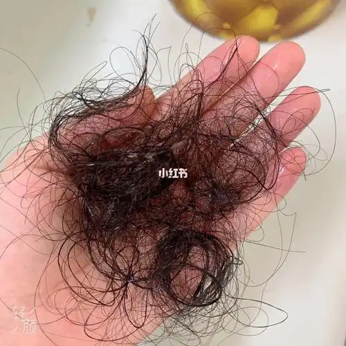 医生说人每天掉一百根头发正常