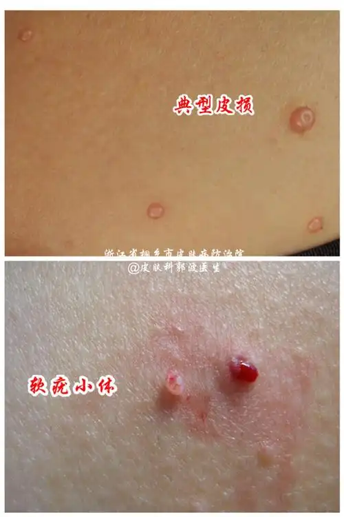 传染性软疣(水瘊子)的防治!