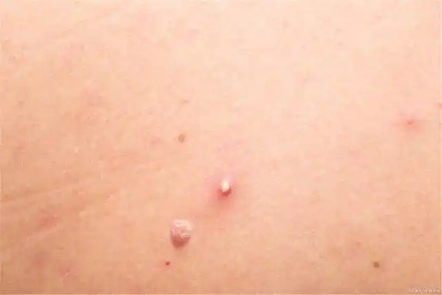 脖子上的"小肉粒"是什么?可以用手抠吗?别不当回事